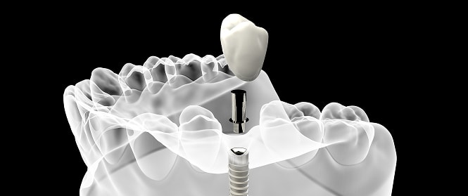 Dental Implant Model